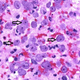 Microscopic image of a sample taken from the woman’s brain, with arrows indicating the amoebas.